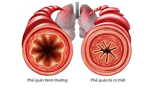 Viêm phế quản co thắt là tình trạng viêm đường dẫn khí lớn của phổi